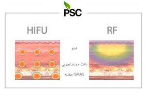 تفاوت هایفو و آر اف