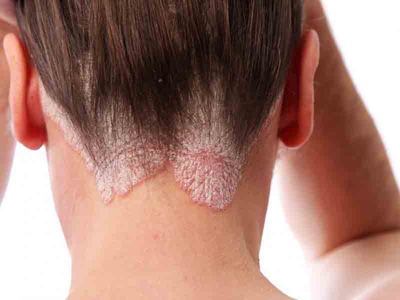 دربارۀ این مقاله بیشتر بخوانید پسوریازیس چیست؟