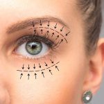 جراحی بلفاروپلاستی پلک فوقانی: بازسازی زیبایی چشمان شما